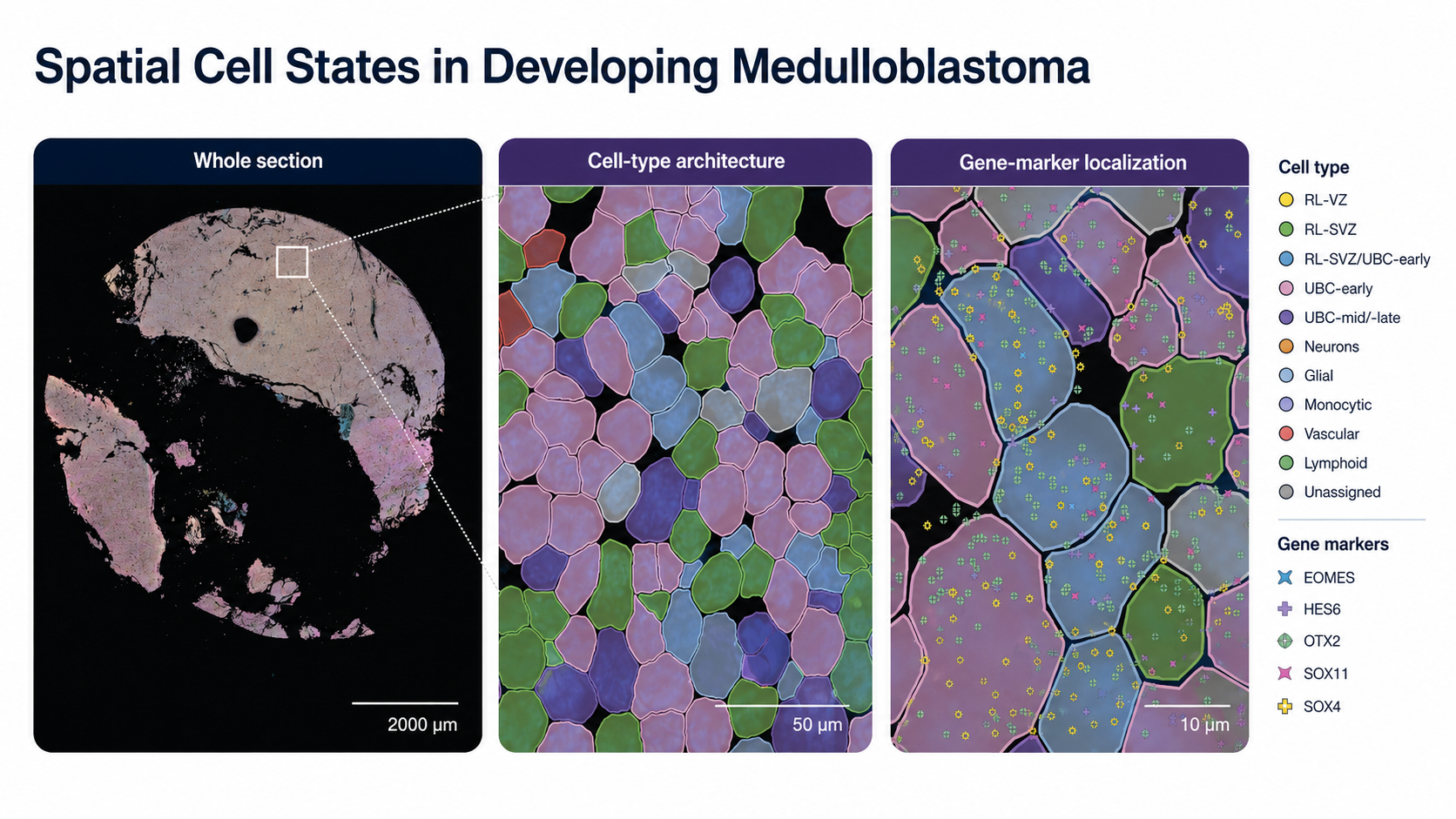 Whole medulloblastoma tissue section with magnified cell-type architecture and EOMES, HES6, OTX2, SOX11, and SOX4 marker localization, with legends and scale bars.