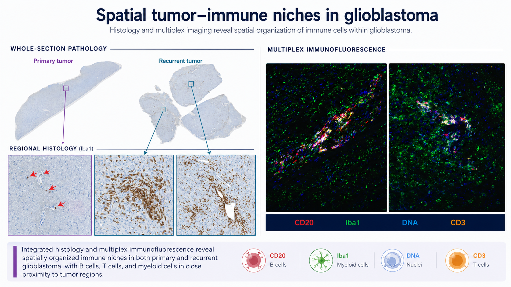 Primary and recurrent glioblastoma tissue sections with regional Iba1 histology and multiplex immunofluorescence panels identifying B cells, myeloid cells, nuclei, and T cells.